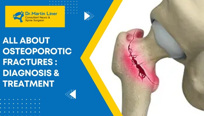 osteoporotic fractures